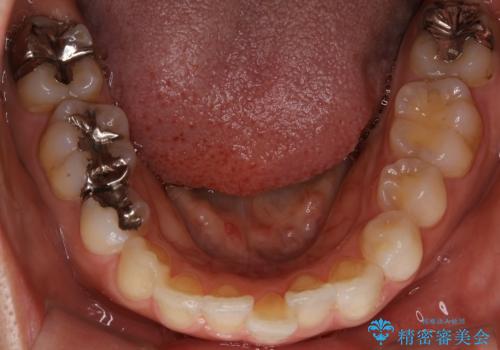 前歯のガタつきを改善 抜歯矯正後の後戻りの治療前
