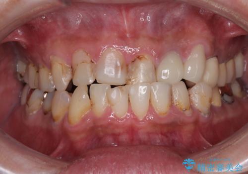 受け口傾向の咬み合わせを治したい 全顎セラミック治療の症例 治療前