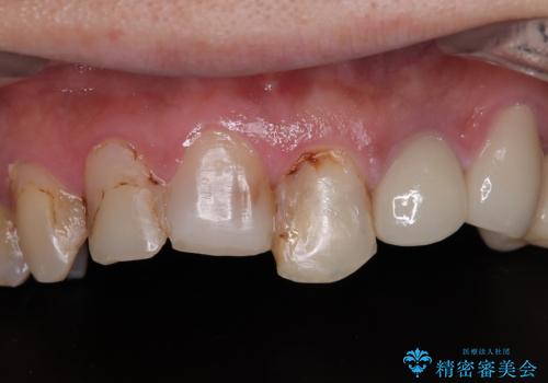 受け口傾向の咬み合わせを治したい 全顎セラミック治療の治療前