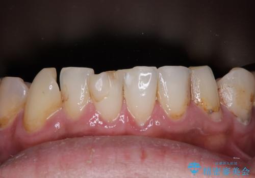 受け口傾向の咬み合わせを治したい 全顎セラミック治療の治療前