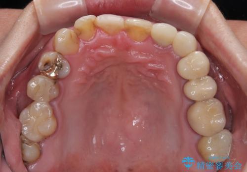 受け口傾向の咬み合わせを治したい 全顎セラミック治療の治療前