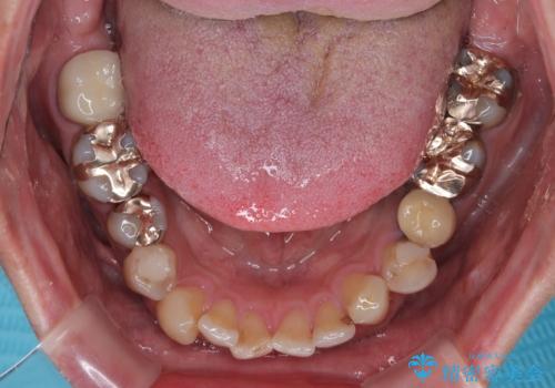 受け口傾向の咬み合わせを治したい 全顎セラミック治療の治療前