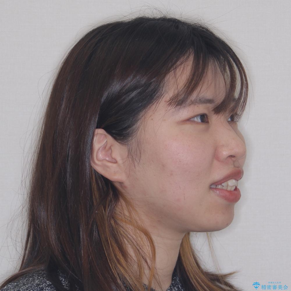 【モニター】口が閉じられない ワイヤー装置での抜歯矯正の治療前(顔貌)