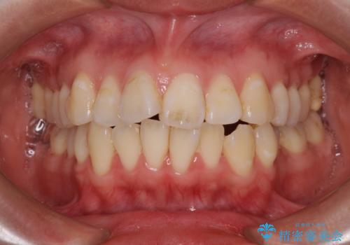 【モニター】口が閉じられない ワイヤー装置での抜歯矯正の症例 治療前