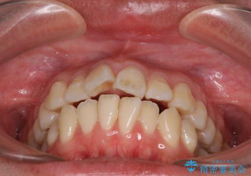 【モニター】口が閉じられない ワイヤー装置での抜歯矯正の治療前