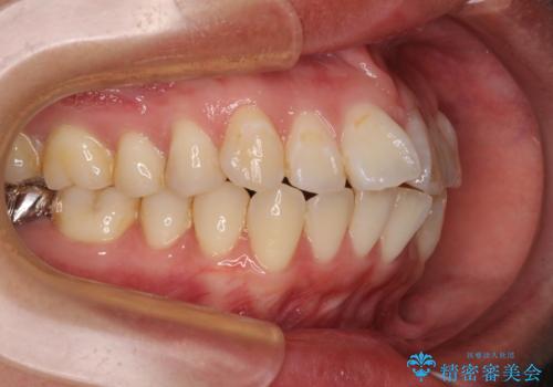 【モニター】口が閉じられない ワイヤー装置での抜歯矯正の治療前