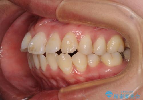 【モニター】口が閉じられない ワイヤー装置での抜歯矯正の治療前