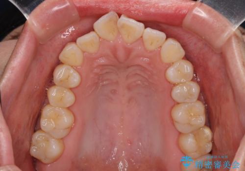 【モニター】口が閉じられない ワイヤー装置での抜歯矯正の治療前