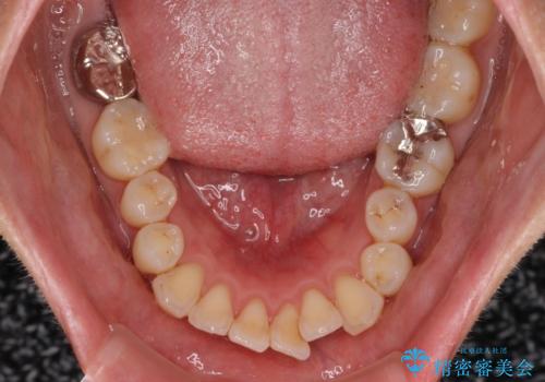 【モニター】口が閉じられない ワイヤー装置での抜歯矯正の治療前