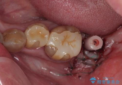 インプラント治療を含む精密審美治療の治療中