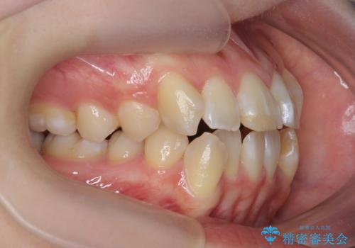 突き出た前歯を治したい 小臼歯抜歯+マルチブラケット矯正の治療前