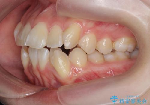 突き出た前歯を治したい 小臼歯抜歯+マルチブラケット矯正の治療前