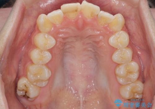突き出た前歯を治したい 小臼歯抜歯+マルチブラケット矯正の治療前