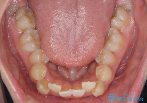 突き出た前歯を治したい 小臼歯抜歯+マルチブラケット矯正の治療前