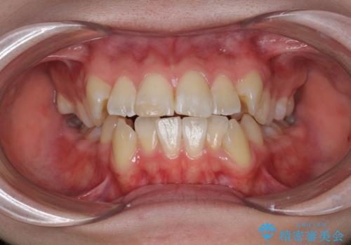 突き出た前歯を治したい 小臼歯抜歯+マルチブラケット矯正の症例 治療前