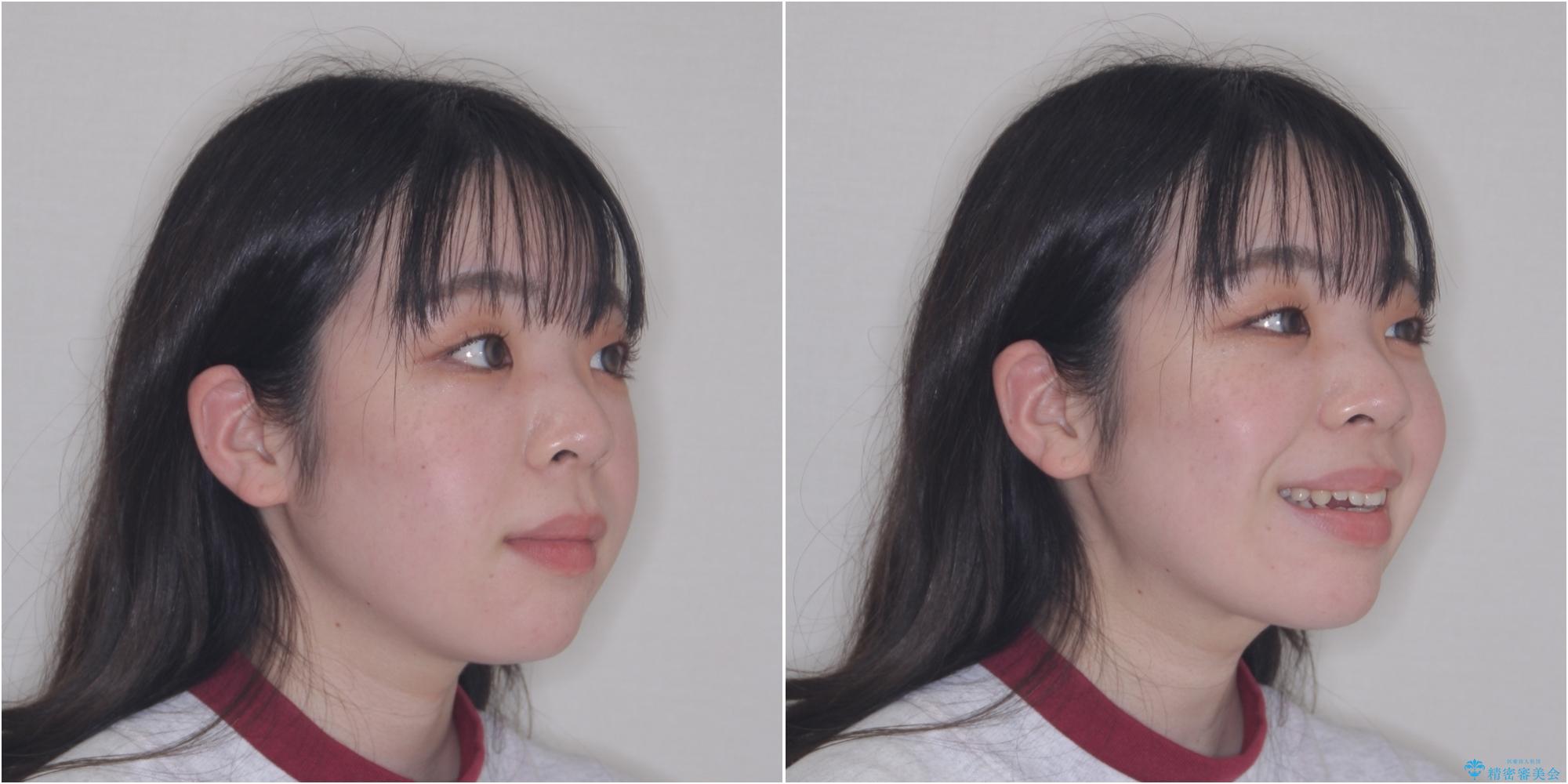 【モニター】舌突出癖で隙間が ワイヤー装置での抜歯矯正の治療前(顔貌)