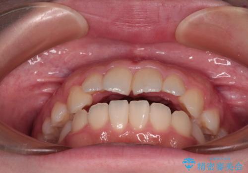 【モニター】舌突出癖で隙間が ワイヤー装置での抜歯矯正の治療前