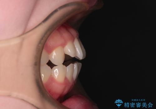 【モニター】舌突出癖で隙間が　ワイヤー装置での抜歯矯正の治療前
