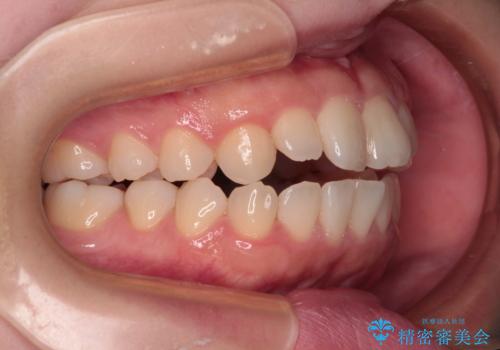 【モニター】舌突出癖で隙間が ワイヤー装置での抜歯矯正の治療前