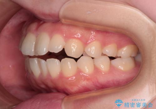 【モニター】舌突出癖で隙間が ワイヤー装置での抜歯矯正の治療前