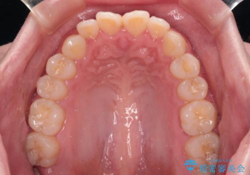 【モニター】舌突出癖で隙間が ワイヤー装置での抜歯矯正の治療前