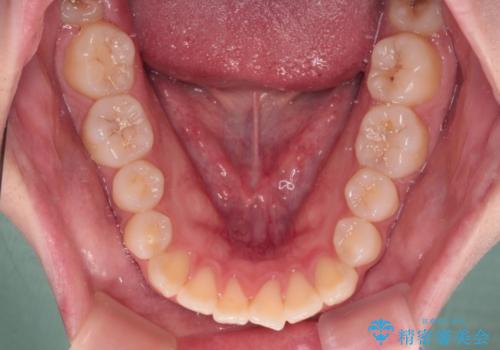 【モニター】舌突出癖で隙間が ワイヤー装置での抜歯矯正の治療前