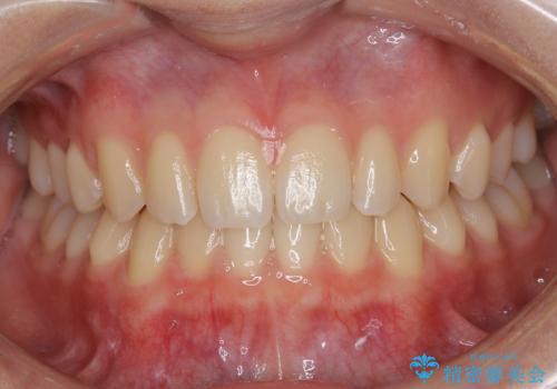 空隙歯列弓・正中離開(すきっ歯)の症例 治療後
