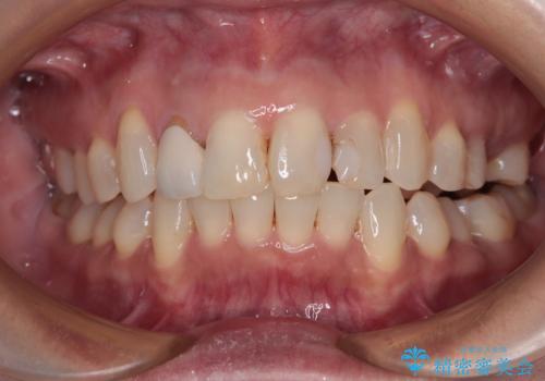 前歯のデコボコとむし歯治療の跡 インビザライン矯正とオールセラミッククラウン治療の治療中