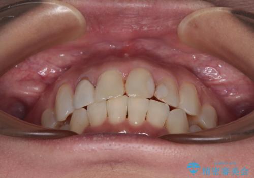 前歯のデコボコとむし歯治療の跡 インビザライン矯正とオールセラミッククラウン治療の治療中