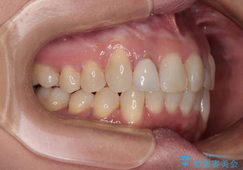 前歯のデコボコとむし歯治療の跡 インビザライン矯正とオールセラミッククラウン治療の治療中