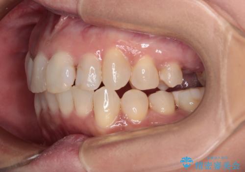 前歯のデコボコとむし歯治療の跡 インビザライン矯正とオールセラミッククラウン治療の治療中