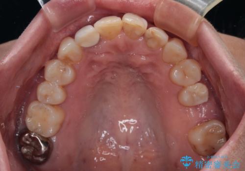 前歯のデコボコとむし歯治療の跡 インビザライン矯正とオールセラミッククラウン治療の治療中