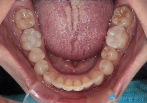 前歯のデコボコとむし歯治療の跡 インビザライン矯正とオールセラミッククラウン治療の治療中