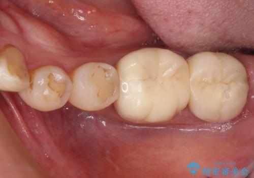 骨よりも深く進行したむし歯 即時荷重インプラントでの短期間治療の症例 治療前