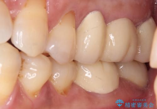 骨よりも深く進行したむし歯 即時荷重インプラントでの短期間治療の治療前