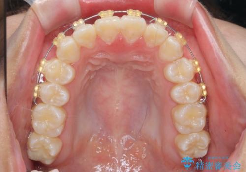 上下すれ違った前歯の矯正治療の治療中