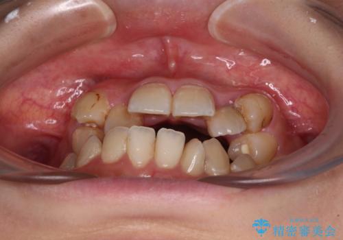 むし歯と八重歯を治したい 総合歯科治療の治療前
