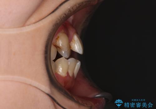 むし歯と八重歯を治したい 総合歯科治療の治療前