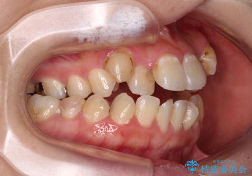 むし歯と八重歯を治したい 総合歯科治療の治療前