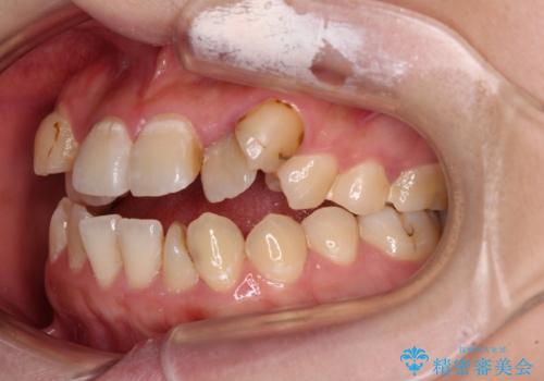 むし歯と八重歯を治したい 総合歯科治療の治療前