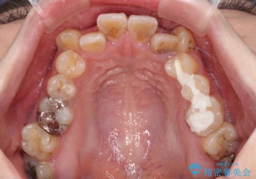 むし歯と八重歯を治したい 総合歯科治療の治療前