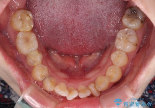 むし歯と八重歯を治したい 総合歯科治療の治療前