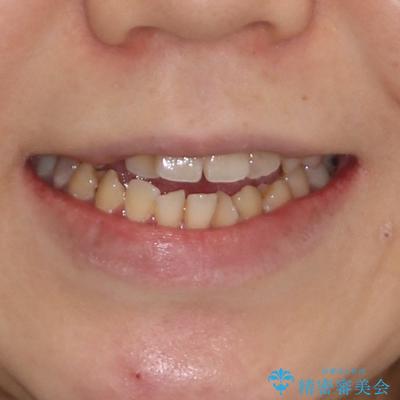 むし歯と八重歯を治したい 総合歯科治療の治療前(顔貌)