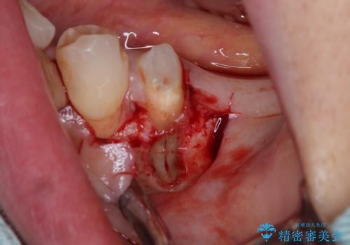 放置していたむし歯 抜歯即時埋入インプラントによる補綴治療の治療中