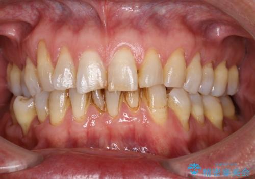 コーヒーなどでついた濃い着色の除去の症例 治療前