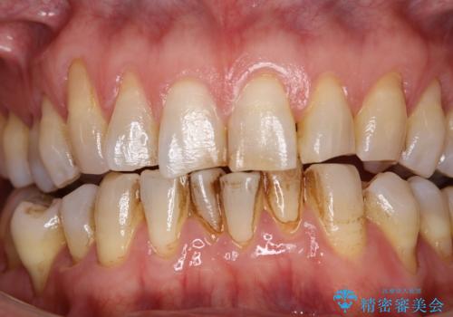 コーヒーなどでついた濃い着色の除去の治療前