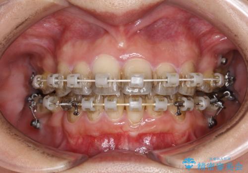 ワイヤー矯正治療中に歯の着色を綺麗にの症例 治療前