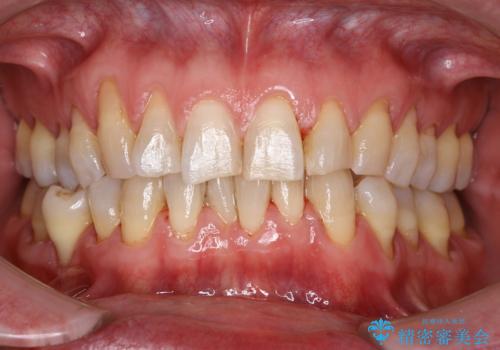 コーヒーなどでついた濃い着色の除去の症例 治療後