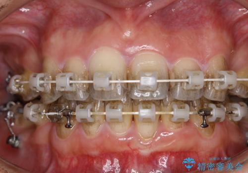 ワイヤー矯正治療中に歯の着色を綺麗にの治療前