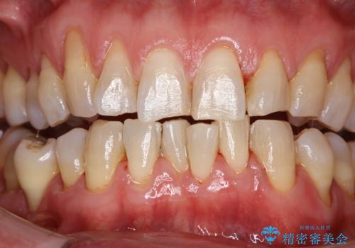 コーヒーなどでついた濃い着色の除去の治療後